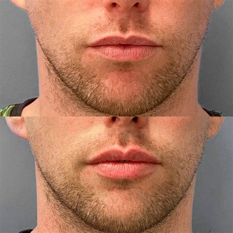 lip injections