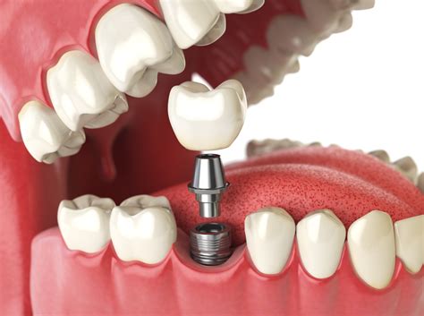 financing  dental implants dental news network