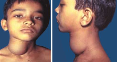 15A and B: Cystic hygroma | Download Scientific Diagram