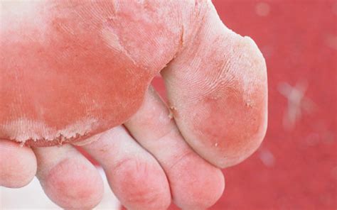 Athlete’s Foot Causes, Symptoms, and Treatment