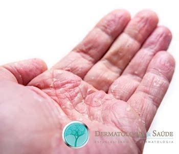 Alimentos Que Pioram A Disidrose - Disidrose - Dermatologia e Saude