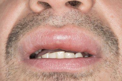 swollen lip stock image  science photo library