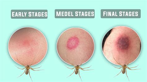 Brown Recluse Spider Bite Pictures Early Stages