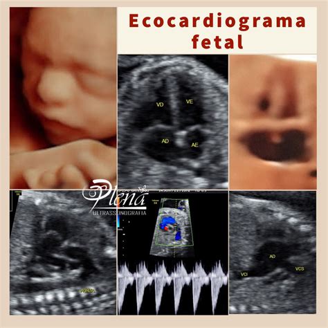 Como É Feito O Exame Ecocardiograma Fetal