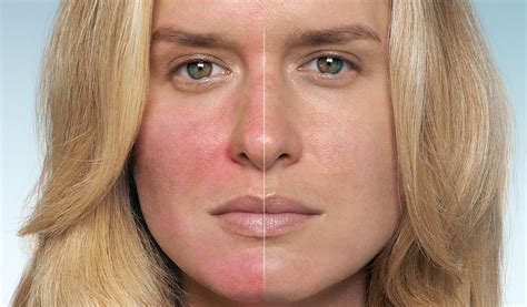 Rosacea (Růžovka) - Nemoci - Vitalia.cz