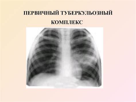 Первичный туберкулёз у детей и подростков - презентация онлайн
