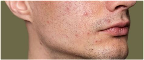 nggak perlu beli   membuat acne spot  atasi bekas