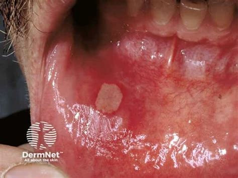 aphthous ulceration aphthae ulcers