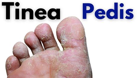 tinea pedis