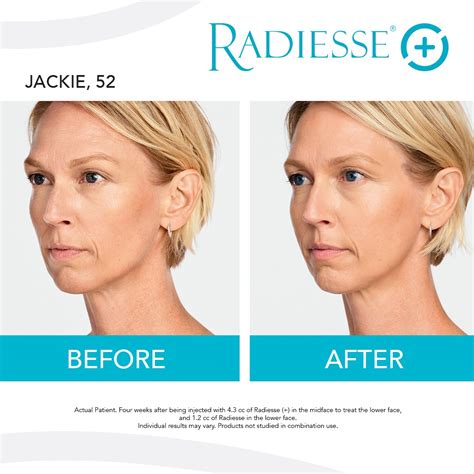 radiesse treatment gallery chicago skin clinic patient results