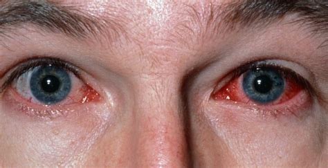 Overview of Conjunctivitis - Vision Magazine Online