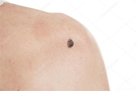 Keratinizing squamous cell carcinoma of the skin — Stock Photo ...