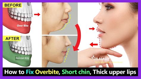 How To Cure Overbite - Proofcheek Spmsoalan