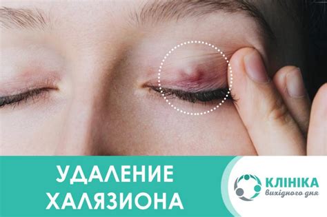 Халязион На Глазу Фото — Фото