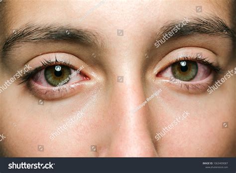 427 Woman Pollen Itchy Eyes Images, Stock Photos & Vectors | Shutterstock