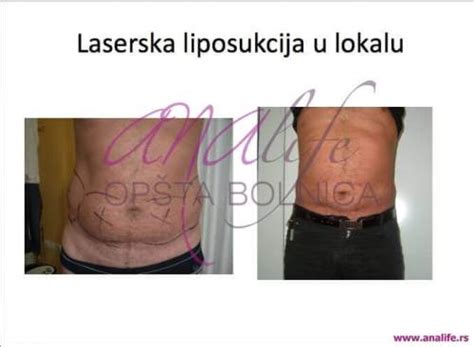 Laserska Liposukcija u lokalu :: Opšta Bolnica Analife