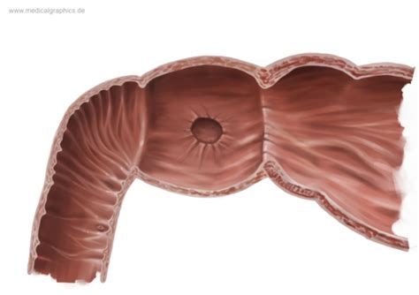 Free Illustration Duodenal ulcer