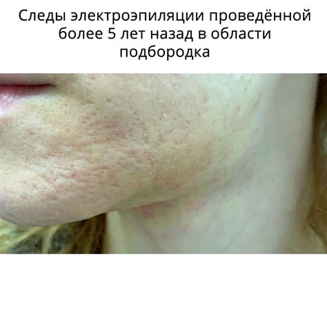 Электроэпиляция