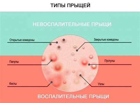 Виды прыщей на теле у женщины схема и описание