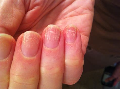 VIRTUAL GRAND ROUNDS IN DERMATOLOGY 2.0: Nail Dystrophy in a Nurse