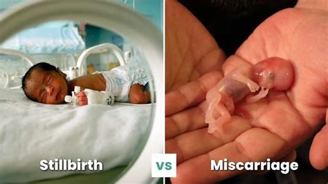 Stillbirth vs Miscarriage: Know The Differences