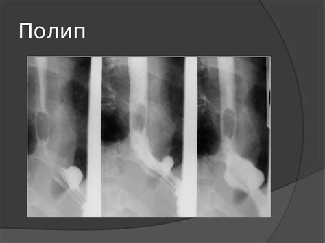 Опухоли пищевода - презентация онлайн