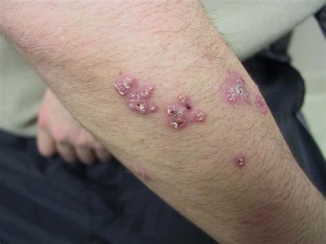 Blastomycosis Skin Lesions