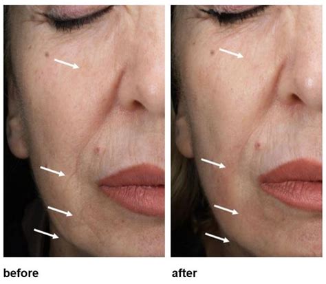 deep chemical peels treat signs  ageing  dark spots