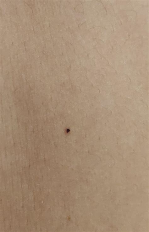 Little Black Dots On Skin Ever Noticed These Small Black Dots On Your