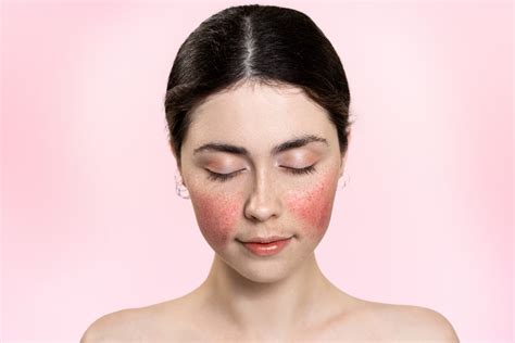 What is rosacea - rosacea? What are its causes, symptoms (spots on the ...