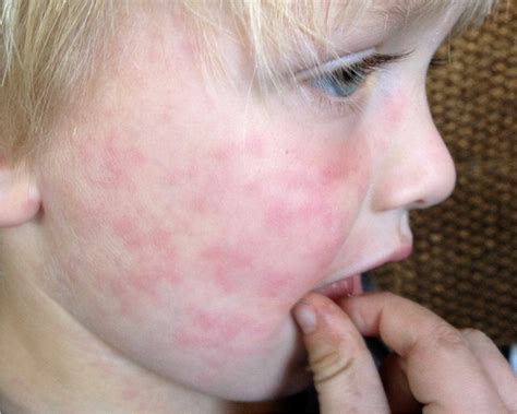 Skin Rashes In Children