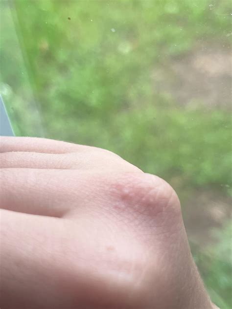 Small, itchy bumps on my knuckle… who or what is the culprit? : r