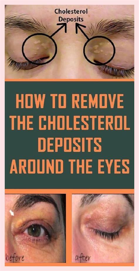 How to Remove Cholesterol Deposits Around Your Eyes