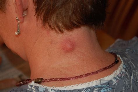 Why Does My Sebaceous Cyst Keep Coming Back? | Plastic Surgery OH
