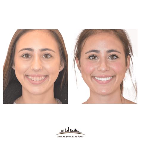 TMJ Surgery | Dallas Oral Surgery