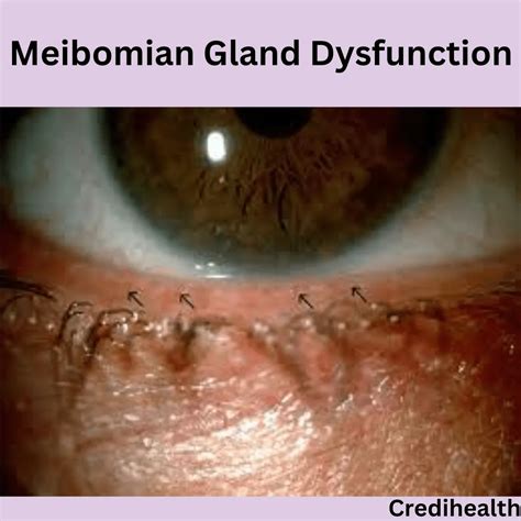 Meibomian Gland Dysfunction: Causes, Symptoms and Treatment Options