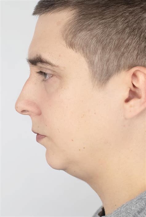 Weak Jaw | Zenith Cosmetic Clinics