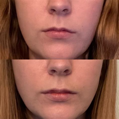 What Does 0.5Ml Lip Filler Look Like at Randy Stambaugh blog