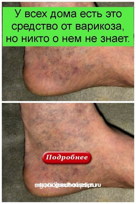 Разное | Постила | Варикоз, Товары для здоровья, Здоровье
