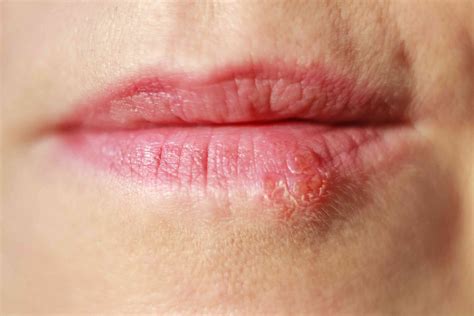 Herpes Inside Nose