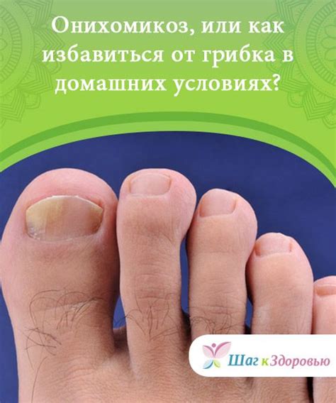 Онихомикоз, или как избавиться от грибка в домашних условиях? | Лечение ...