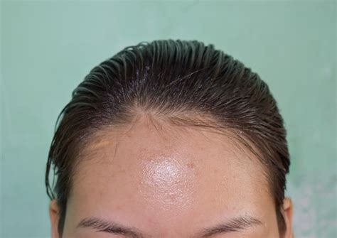biggest forehead   world  pictures tukocoke