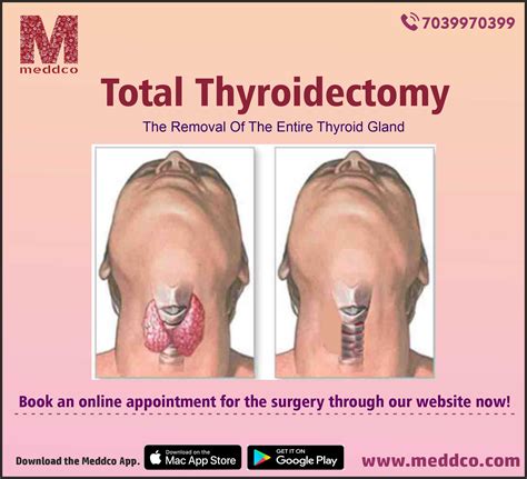 prepare   total thyroidectomy surgery