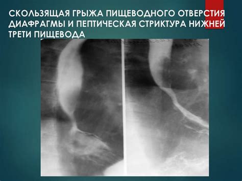 Грыжи живота. Осложненные грыжи. Диагностика и хирургическая тактика ...