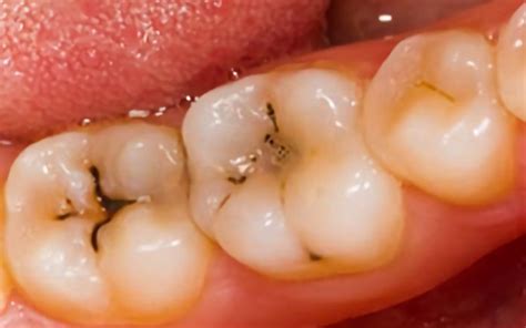 What are dental caries? - Dentistry by Dr. Sferlazza - Mississauga, ON ...