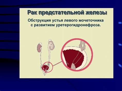 Рак предстательной железы - презентация онлайн