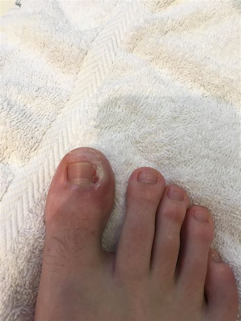 My toe post ingrown toenail removal procedure. Was infected before