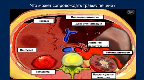 Травмы печени. Тактика хирургического лечения. Способы остановки ...