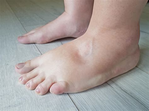 Best Gradient Compression Socks for Edema Relief | Care-Med LTD