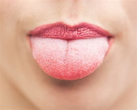 Рак языка: признаки и симптомы, фото начальной стадии, лечение, сколько ...